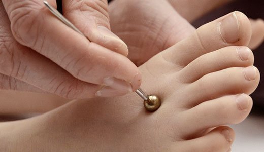 In der Akupunktur für Kinder kommen keine Nadeln zum Einsatz.