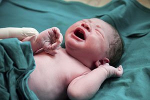 Warum die Geburt per Kaiserschnitt so beliebt ist