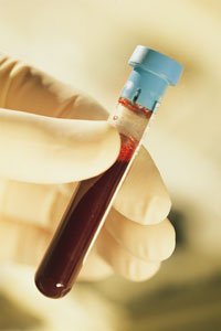 Bald kann Trisomie 21 durch einen Bluttest nachgewiesen werden