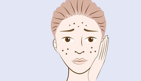 L'acné s'infiltre également sous la peau. Témoignages de blogueurs sur leur combat émotionnel et physique contre les boutons.