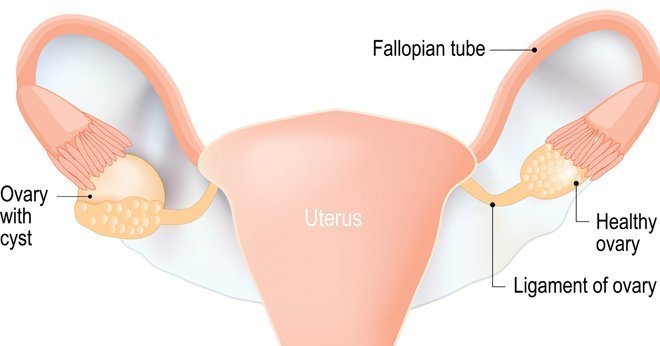 Utérus avec ovaires polykystiques (syndrome PCO).