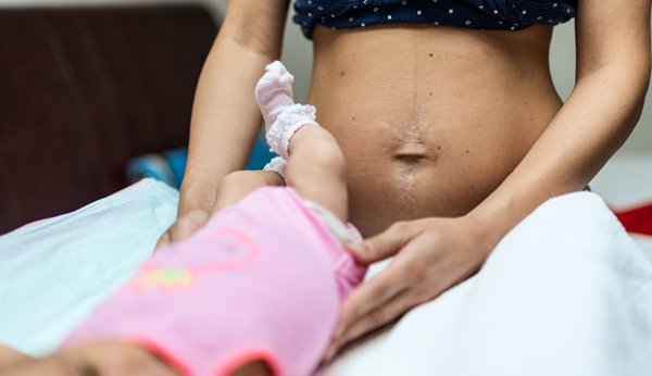 After-Baby-Body: Frau mit Dehnungsstreifen auf dem Bauch wickelt ihr Baby