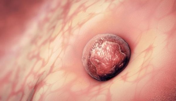 L'implantation de l'ovule dans l'utérus