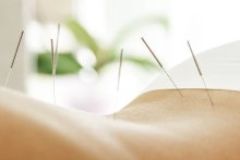 Alternativmedizin: Akupunktur für gestresste Eltern
