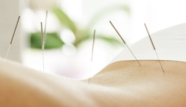 Alternativmedizin wie Akupunktur kann helfen, Stress abzubauen.