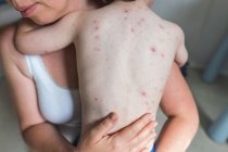 Wilde Blattern: Warum die Windpocken-Impfung dein Kind gleich doppelt schützt