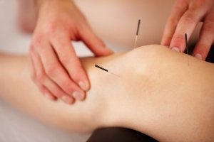 So kann dir Akupunktur während der Schwangerschaft helfen