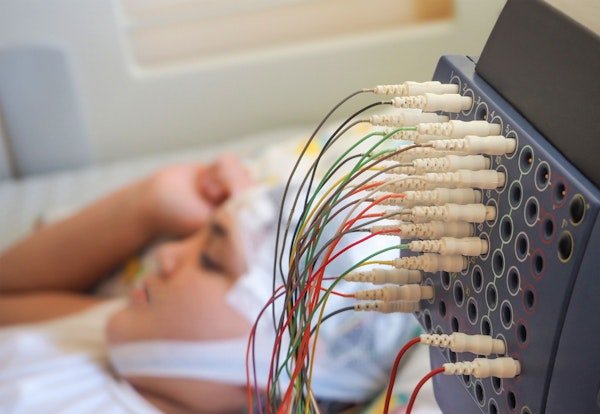 Bei einem Mädchen mit EEG-Elektroden am Kopf werden die Hirnströme gemessen, um abzuklären, ob sie an Epilepsie leidet.