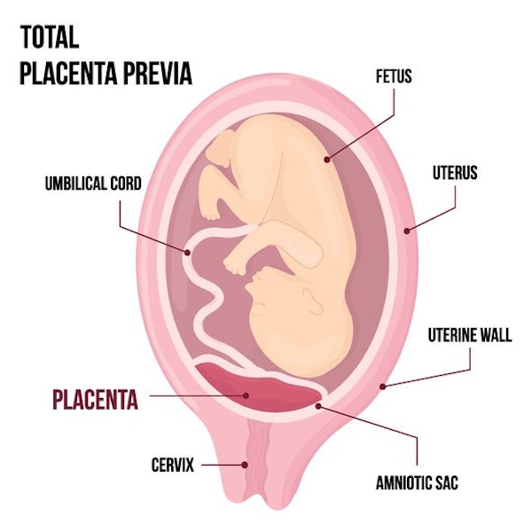 So liegt die Placenta praevia totalis.