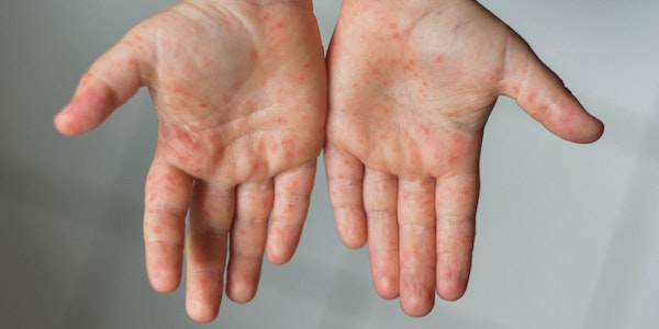 Hand-Mund-Fuss-Krankheit: Kind zeigt Handflächen voller Bläschen 