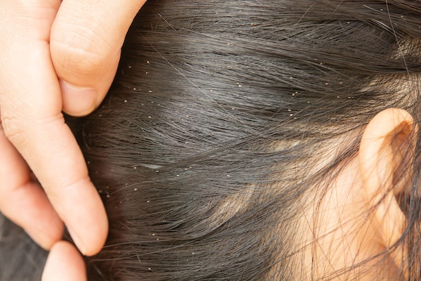 Nahaufnahme von Haaransatz mit zurückgestrichenem Haar, in dem zahlreiche Nissen (Läuseeier) zu erkennen sind.