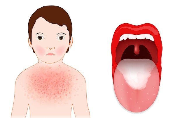 Grafik: Kind mit Scharlach-Ausschlag auf Brust und roten Wangen, geöffneter Mund mit belegter Zunge und entzündetem Gaumen