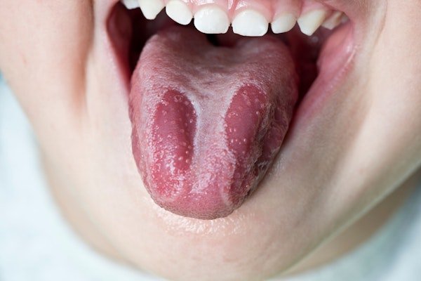 untere Gesichtshälfte eines Kindes, das die Zunge herausstreckt, diese ist weiss belegt und darunter sehr rot.