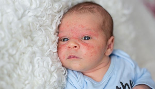Un neonato soffre di acne neonatale.