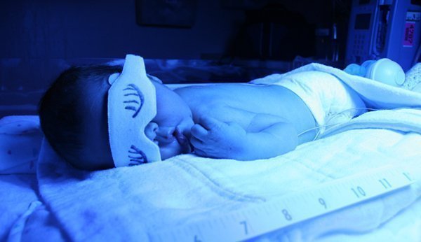 Brustkasten mit blauem Licht, so die herkömmliche Methode gegen Neugeborenen-Gelbsucht