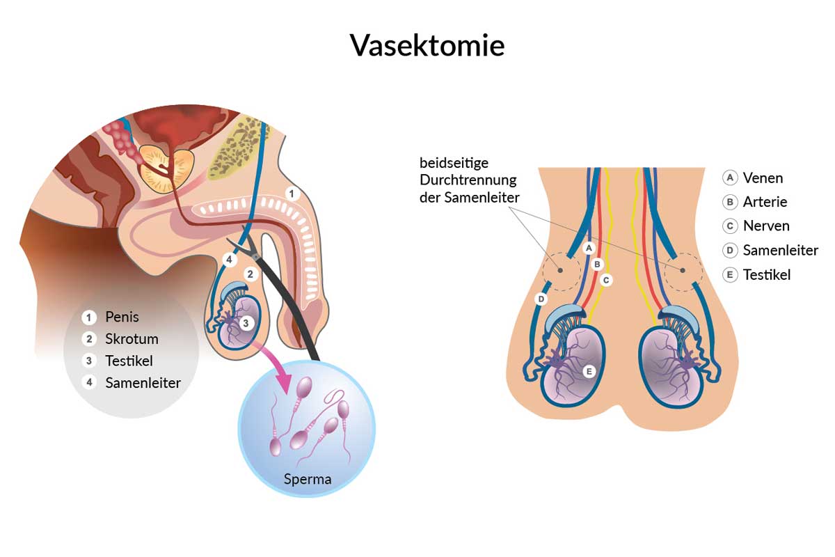 Infografik einer Vasektomie, die das Durchtrennen der Samenleiter zeigt.