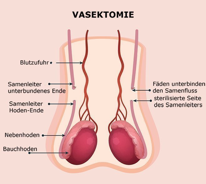 O procedimento para uma vasectomia delineado.