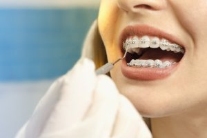 Zahnspange: Mehr als schöne, gerade Zähne?