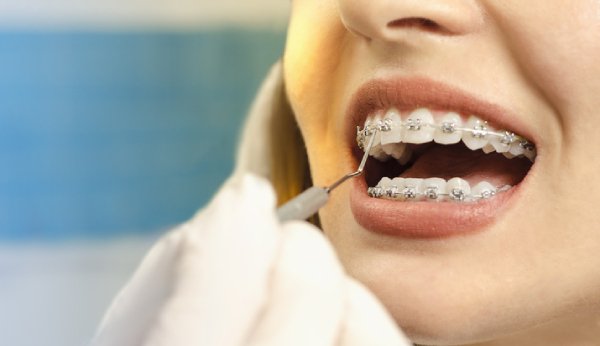 Gegen Zahnfehlstellungen helfen Zahnspangen.