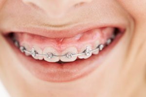 Teures Lächeln: Das kostet eine Zahnspange 